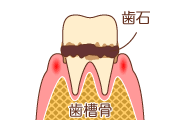 歯周病中度
