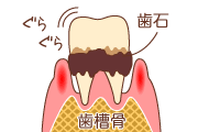 歯周病重度