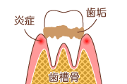 歯周病軽度